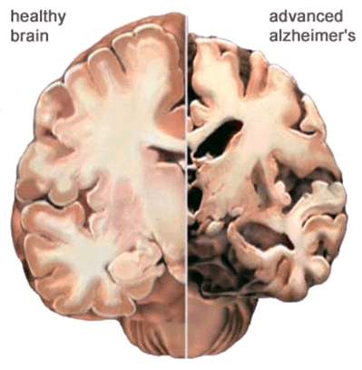 Brain changes, figure 2